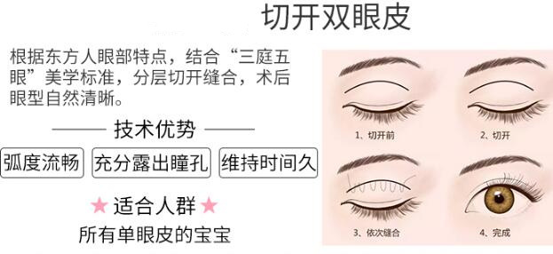 上海九院整形科專家蘇薇潔科普雙眼皮手術(shù)