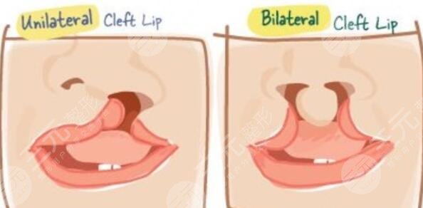 唇腭裂的危害有哪些