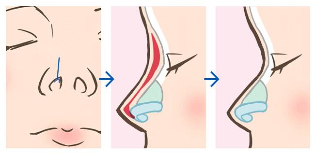 什么是硅膠隆鼻假體取出