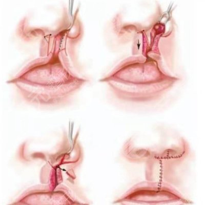 兔唇修復(fù)后的疤痕可以去掉嗎？真人兔唇矯正果：不再有異樣眼光