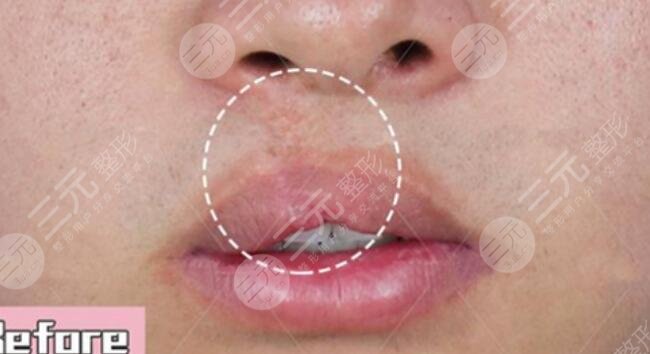 真人兔唇矯正前