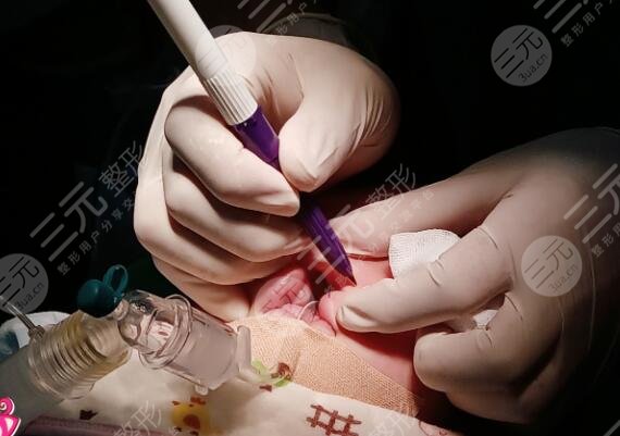 真人兔唇矯正中