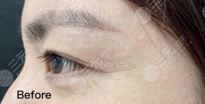 注射注射除皺前