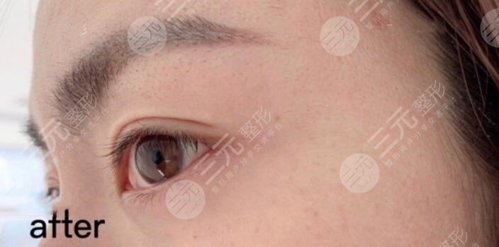 注射注射除皺后