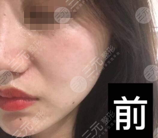 真人體驗激光除皺前