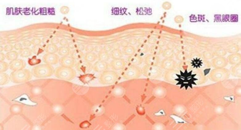 做激光除皺的注意事項(xiàng)