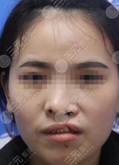 真人做兔唇修復(fù)前