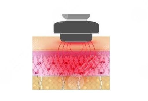深藍射頻間隔多久做一次