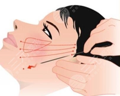 面部拉皮手術(shù)注意事項(xiàng)