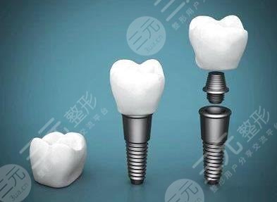 老人有必要做種植牙嗎