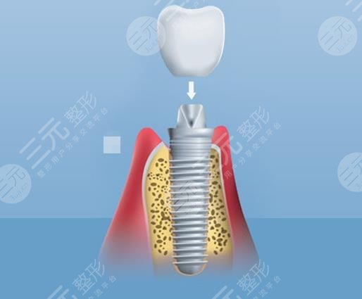 老人有必要做種植牙嗎