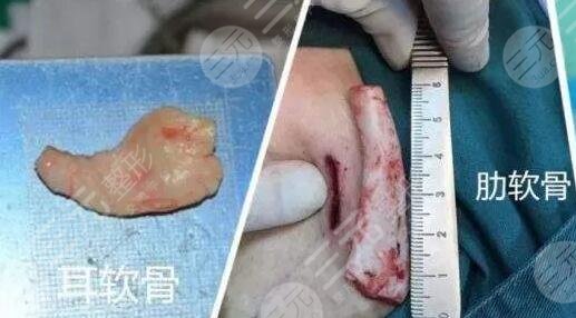 自體軟骨隆鼻優(yōu)勢