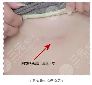 自體軟骨隆鼻術(shù)后注意事項(xiàng)