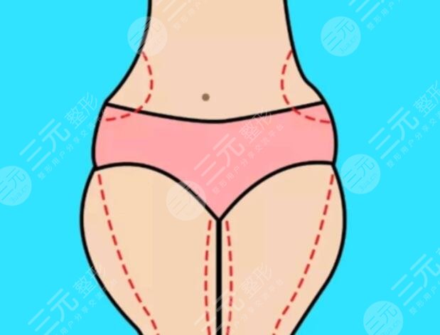 吸脂后可以鍛煉嗎