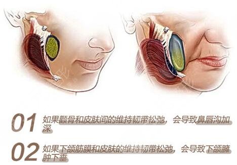 內(nèi)窺鏡除皺術(shù)缺點(diǎn)科普！手術(shù)果到底咋樣？一文解答你的困惑，附價(jià)格~