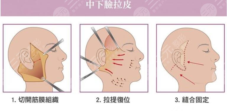 內(nèi)窺鏡拉皮手術(shù)適應(yīng)哪些人群