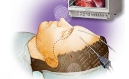 內(nèi)窺鏡拉皮手術(shù)是什么原理