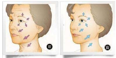 內(nèi)窺鏡拉皮手術(shù)的注意事項(xiàng)