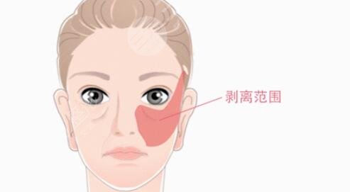 內(nèi)窺鏡拉皮手術(shù)術(shù)后會(huì)有什么樣的改變