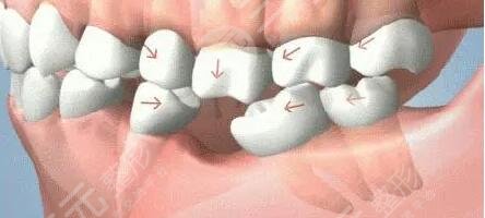 種植牙適應(yīng)的人群