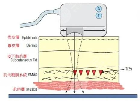 賽諾秀5d膠原光是什么原理
