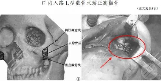 顴骨整形術的疼痛感