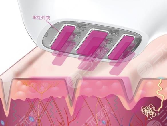 3d射頻美容維持多長時(shí)間