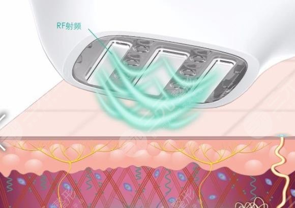 3d射頻美容作用