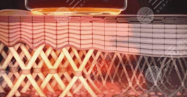 射頻除皺手術術后需要怎么護理