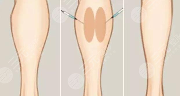 注射瘦腿