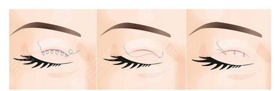 內(nèi)雙怎么變外雙的小竅門