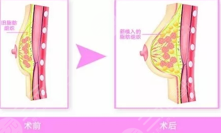 隆胸手術(shù)前要注意什么