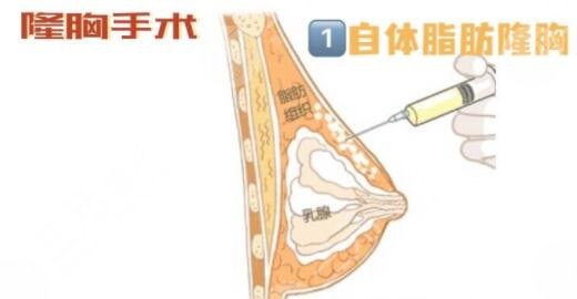 隆胸的方式都有哪些