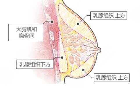 自體脂肪隆胸果好不好