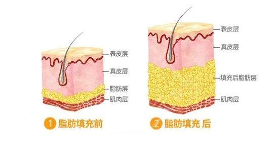 填充額頭多少錢？玻尿酸or自體脂肪？一文詳解豐額頭的秘籍，馬住！