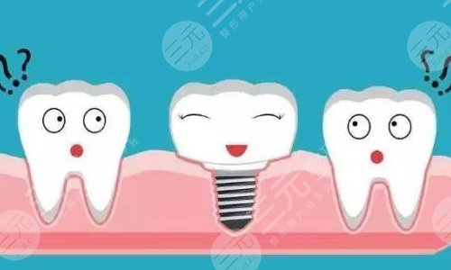 種植牙全程需要幾個(gè)月？種植牙的優(yōu)勢(shì)分析&注意事項(xiàng)