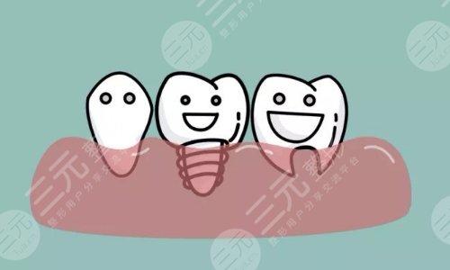 種植牙全程需要幾個(gè)月