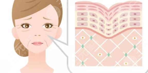 超聲提拉去法令紋果怎么樣