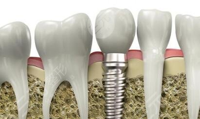 牙齒種植的果顯著嗎