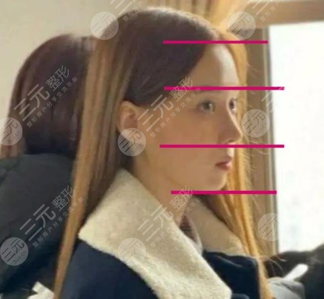 aespa金玟庭(winter)整容了嗎?