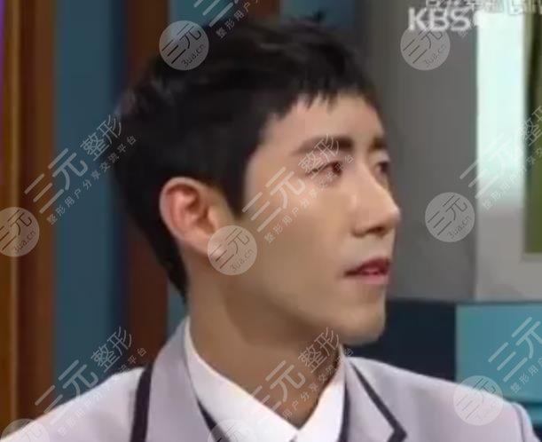 黃光熙近照“換頭”成功整容失敗修復(fù)實(shí)例!