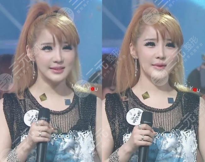 樸春變臉成“怪物”?她動(dòng)了哪些地方?