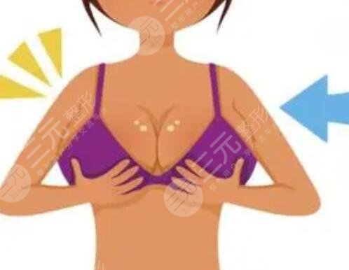 進(jìn)口假體隆胸手術(shù)后平胸妹變身c罩杯