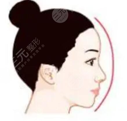 假體隆鼻修復(fù)+肋軟骨墊鼻尖真實案例分享