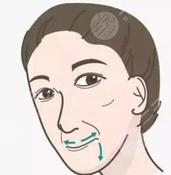 全切雙眼皮+硅膠假體隆鼻前后對比照片，娃娃臉get！