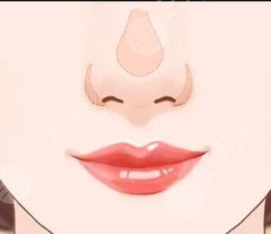 全切雙眼皮+硅膠假體隆鼻前后對比照片，娃娃臉get！