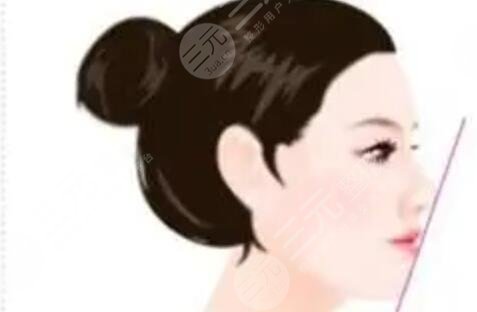 常州施爾美周文自體肋軟骨隆鼻案例