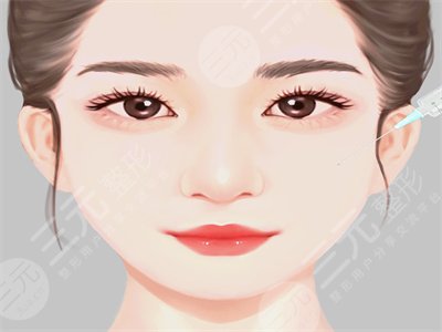 玻尿酸填充,去除法令紋