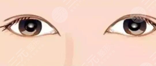 內(nèi)雙,怎么變,外雙,看看,我的,手術(shù),恢復(fù),過程