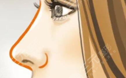 駝峰鼻隆鼻整形價格和案例圖片分享